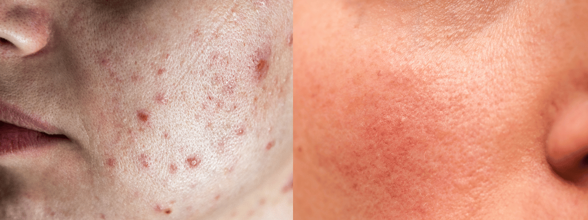 Photos of Retinol side effects