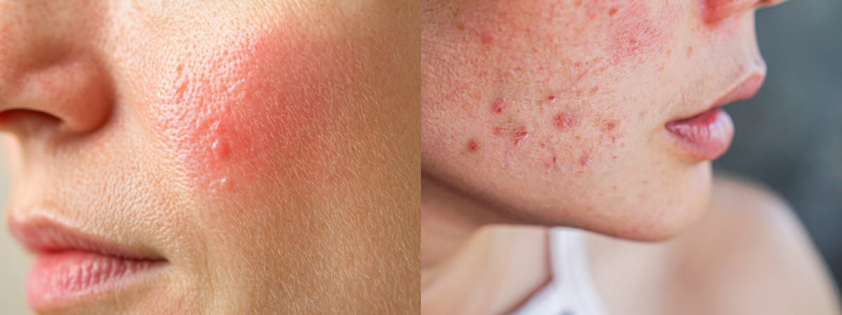 faces of two women with redness